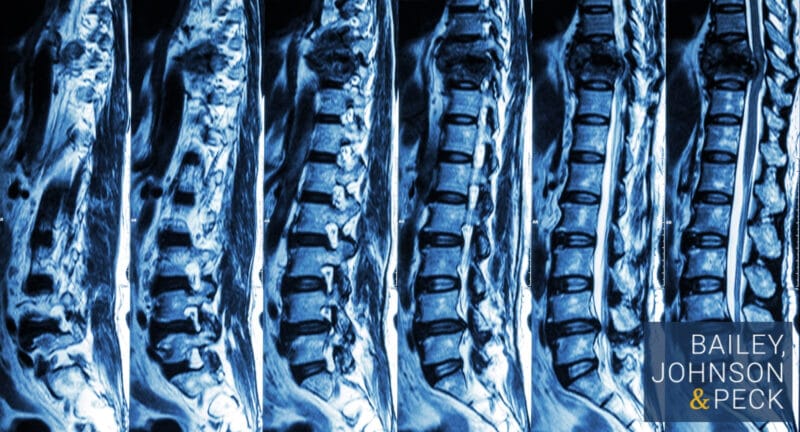 spinal cord injury attorney